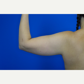 25-34 year old woman treated with Laser Liposuction before 3377073