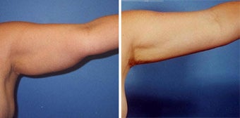 Arm Liposuction before 277392