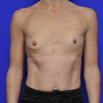 35-44 year old woman treated with Breast Augmentation before 3464080