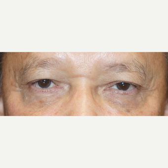 55-64 year old man treated with Ptosis Surgery after 3148561