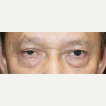 55-64 year old man treated with Ptosis Surgery before 3148561