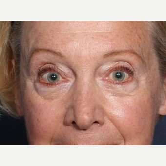 65-74 year old woman treated with Eyelid Surgery before 3709315