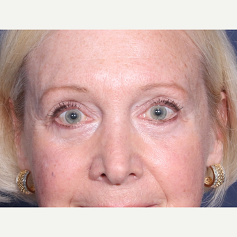 65-74 year old woman treated with Eyelid Surgery after 3709315