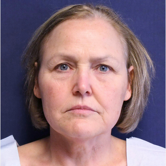Upper Eyelid Lift plus facelift/neck lift, Bellafill for under eyes and around mouth before 3714697