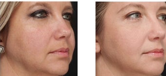 40-year-old woman has marked improvement of Rosacea and Blood Vessels on the face after a series of IPL treatments. before 1088388