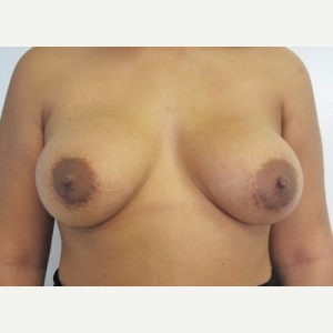 Breast Implant Revision after 3164458