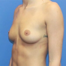 18-24 year old woman treated with Sientra Breast Implants before 1858300