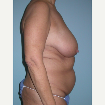 60 year old woman treated with Mommy Makeover before 3375442