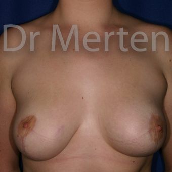 Tuberous breast/asymmetry treated with right breast reduction and left breast lift with implants after 3595385