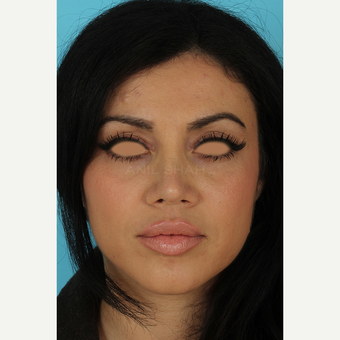 25-34 year old woman treated with Rhinoplasty after 3691329