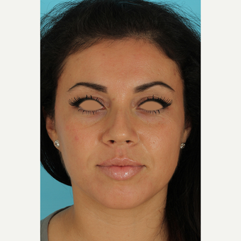 25-34 year old woman treated with Rhinoplasty before 3691329