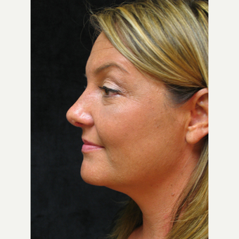 Rhinoplasty after 3343673