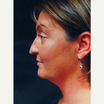 Rhinoplasty before 3343673