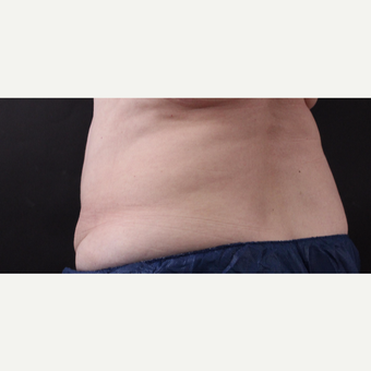 59 year old woman treated with CoolSculpting after 3384613