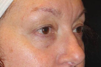 Restylane before 971878