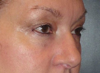 Restylane after 971878