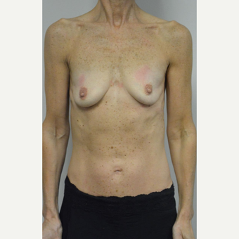 55-64 year old woman treated with Breast Augmentation before 3054965