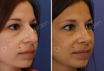 Septorhinoplasty before 1112650