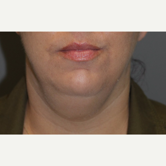 35-44 year old woman treated with Kybella before 3147370