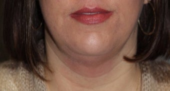 35-44 year old woman treated with Kybella after 3147370