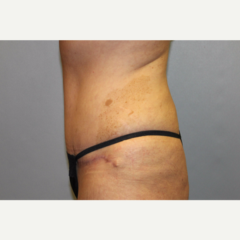 35-44 year old woman treated with Tummy Tuck after 3529107