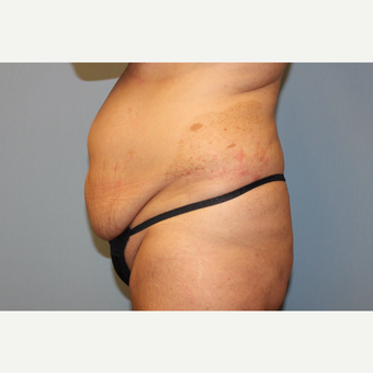 35-44 year old woman treated with Tummy Tuck before 3529107