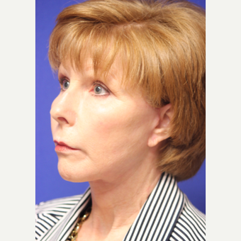 59 year old woman treated with a Lower Face and Neck Lift after 3419635