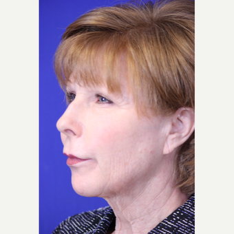 59 year old woman treated with a Lower Face and Neck Lift before 3419635