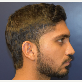 18-24 year old man treated with Septoplasty after 3226882