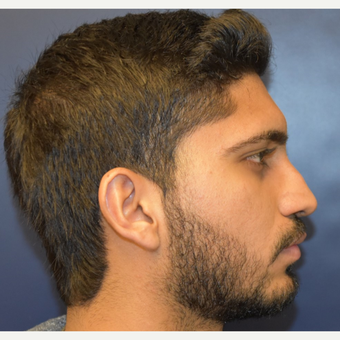 18-24 year old man treated with Septoplasty before 3226882