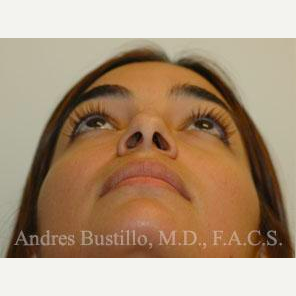 31 year old woman treated with Rhinoplasty before 3460857