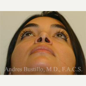 31 year old woman treated with Rhinoplasty after 3460857