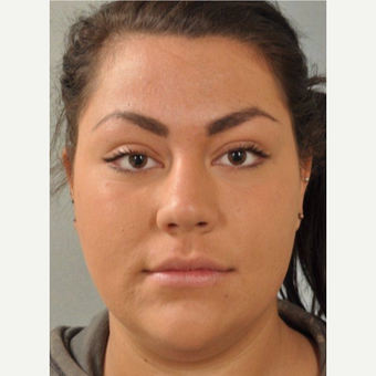 25-34 year old woman treated with Restylane before 3624672