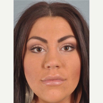 25-34 year old woman treated with Restylane after 3624672