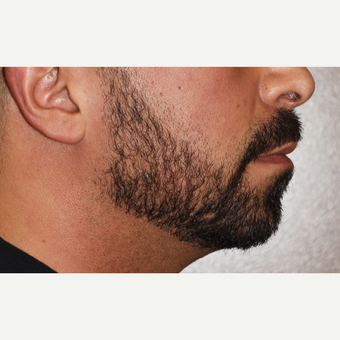 35-44 year old man treated with a Custom Jawline Implant before 3721238