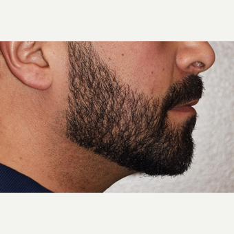 35-44 year old man treated with a Custom Jawline Implant after 3721238