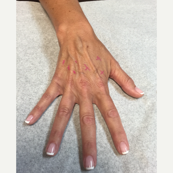 45-54 year old woman treated with Radiesse to the Hands before 3011042
