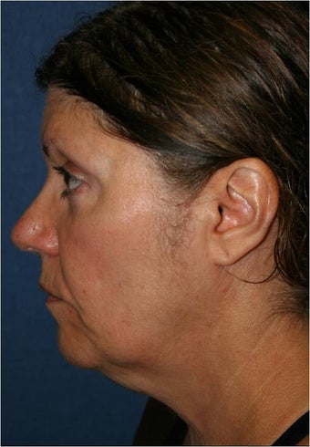61 year old female requesting treatment for her sagging jaw line and neck before 963988