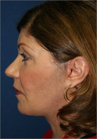 61 year old female requesting treatment for her sagging jaw line and neck after 963988