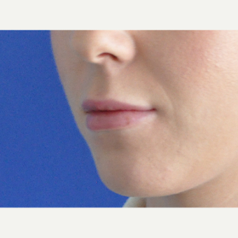 25-34 year old woman treated with Lip Augmentation after 3219357