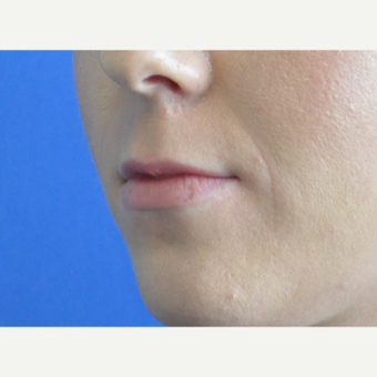 25-34 year old woman treated with Lip Augmentation before 3219357