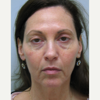 55-64 year old woman treated with Liquid Facelift before 3243197
