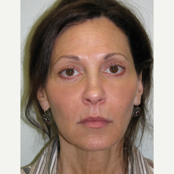 55-64 year old woman treated with Liquid Facelift after 3243197