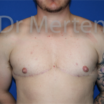 18-24 year old man treated with FTM Chest Masculinization Surgery after 3828888