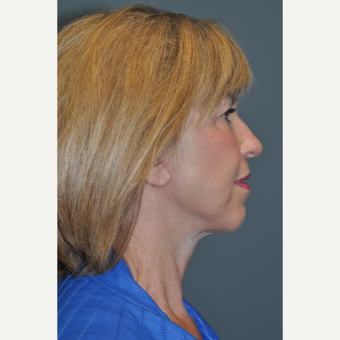 65-74 year old woman treated with Mini Lift after 3508697