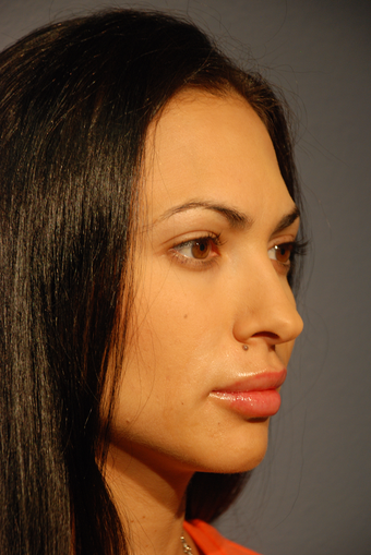 25-34 year old woman treated with Juvederm for Lip Augmentation after 2724231