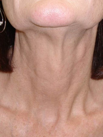 Botox after 989191