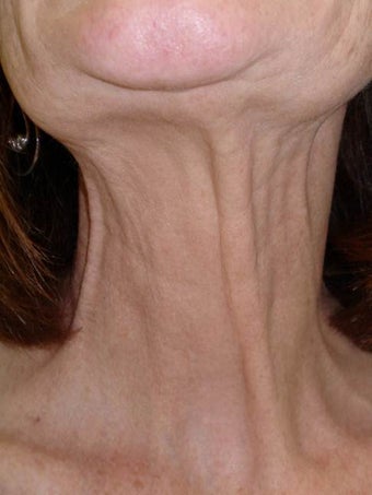 Botox before 989191