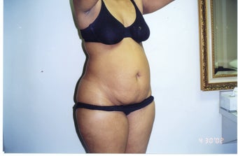 Tummy Tuck and Tumescent Liposuction for a 34-year-old mother of two before 1497873