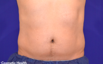 25-34 year old man treated with CoolSculpting after 1713747